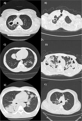 Adaptive immunity in different CT patterns of active tuberculosis and possible variability according to patients' geographic provenience